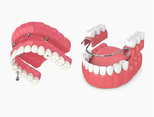 Dental Implants and Denture Solutions