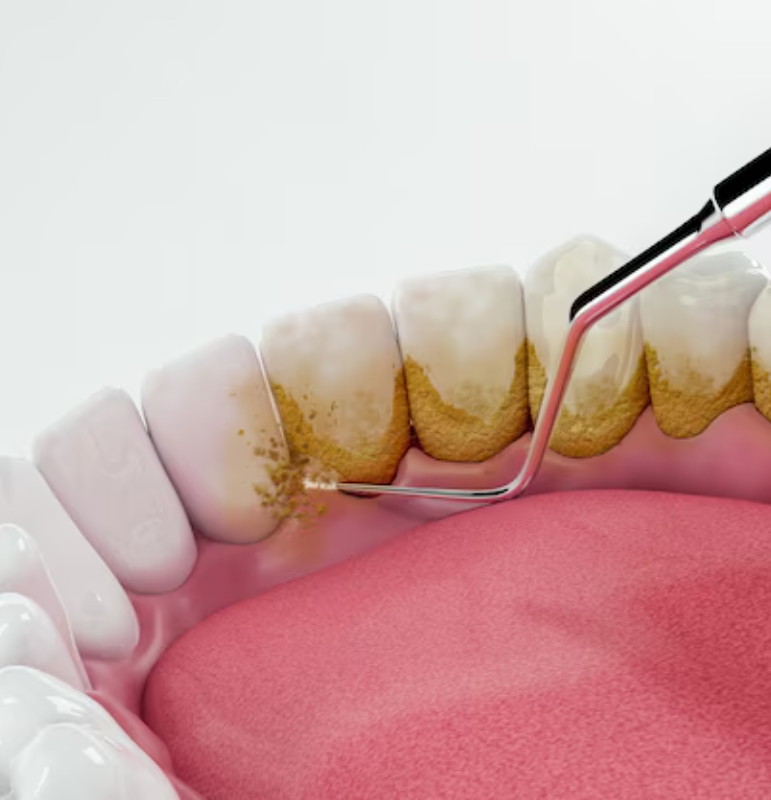 Professional Teeth Cleaning and Whitening in Harare