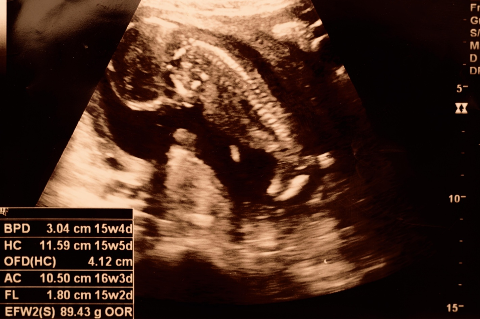 Essential Pregnancy Ultrasound Scans in Harare